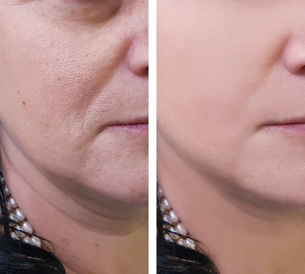 woman wrinkles on face before and after cosmetic procedures