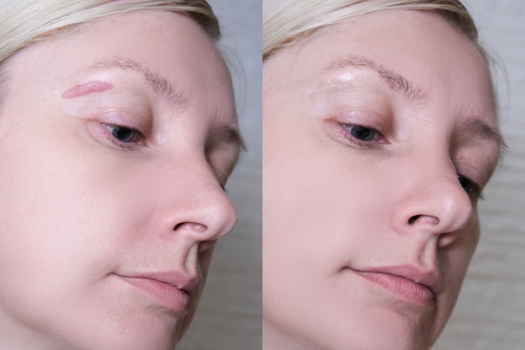 Hypertrophic keloid scar on woman face before and after laser treatment, removal, heal and recovery after accident or damage, cosmetology and pastic surgery solution.