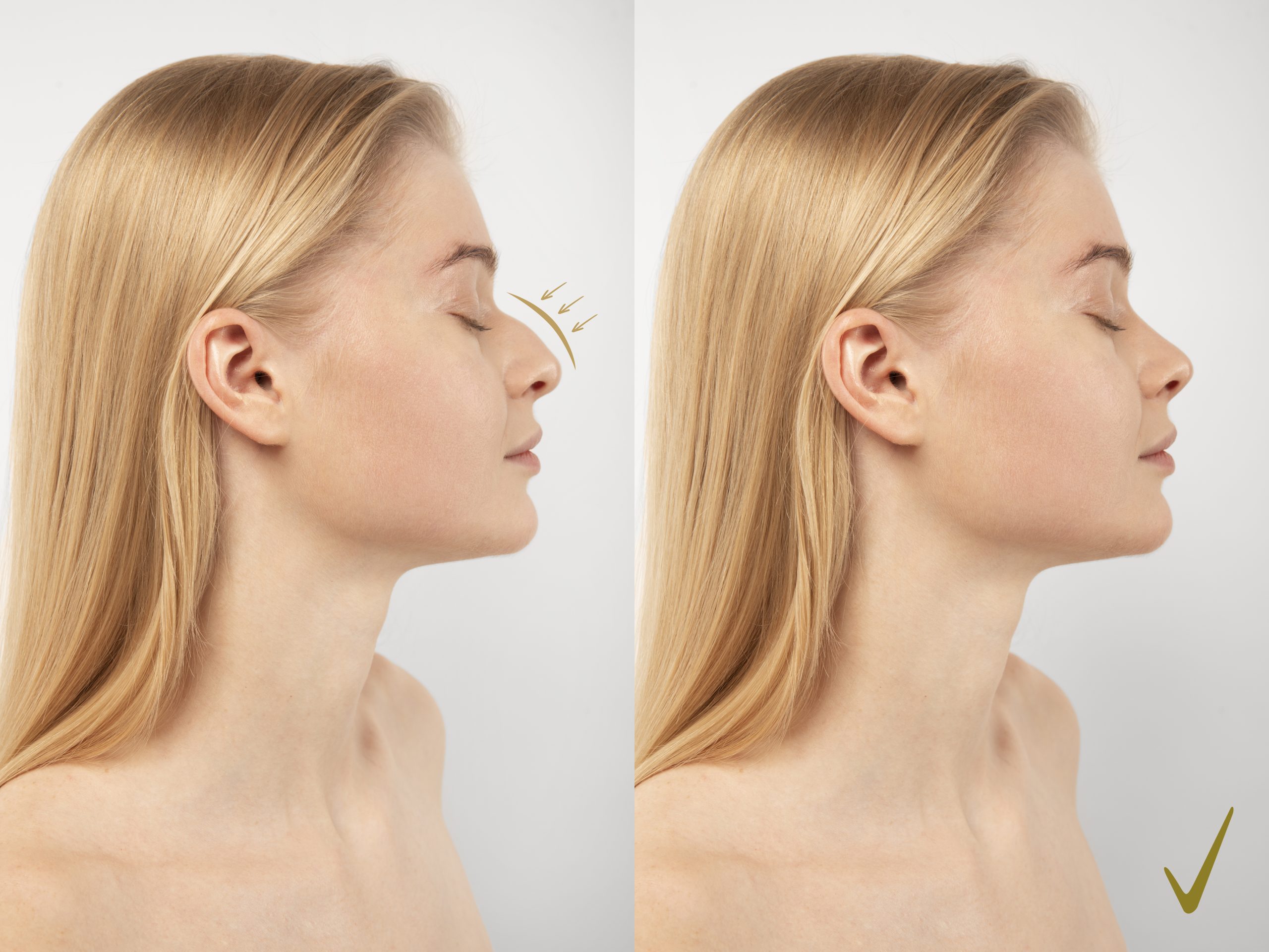 woman-getting-ready-nose-job-surgery