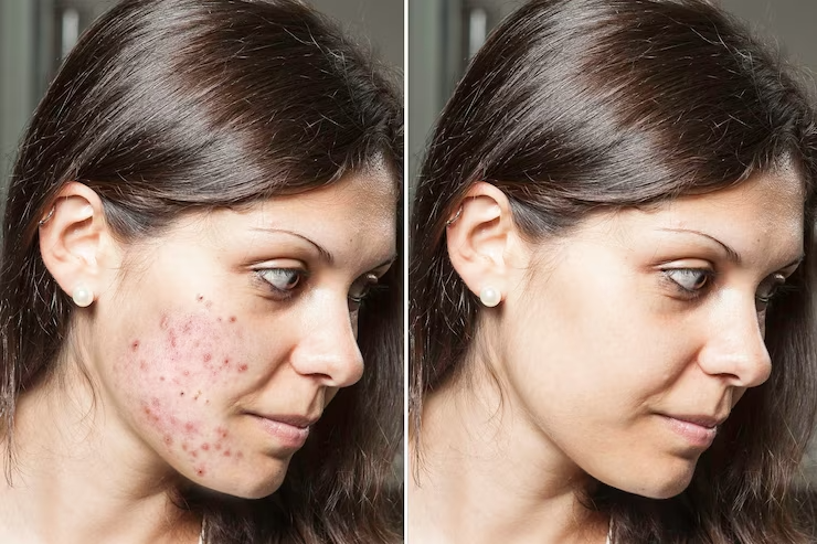 young-woman-with-brunette-hair-shows-before-after-results-successful-acne-treatment-spots-scars-have