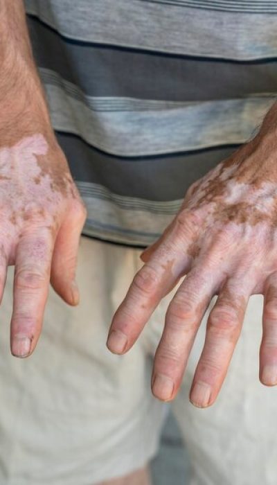 [fpdl.in]_vitiligo-skin-man_246836-4130_normal